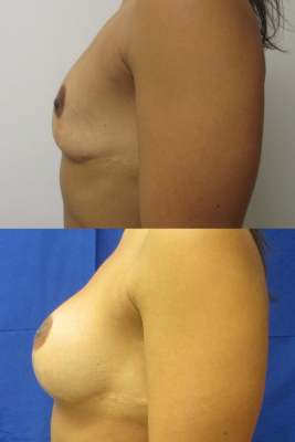 Breast augmentation before & after