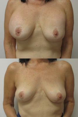 Implant removal & breast lift before and after