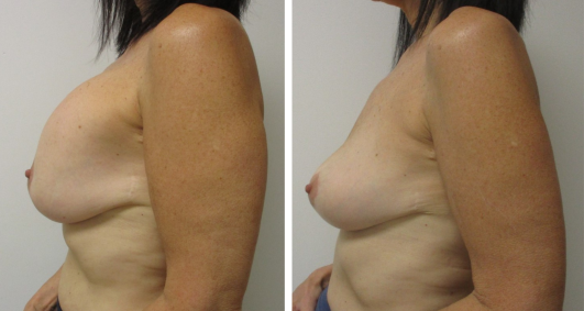 Implant removal & breast lift before and after