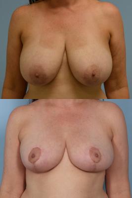 BREAST REDUCTION