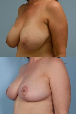 BREAST REDUCTION