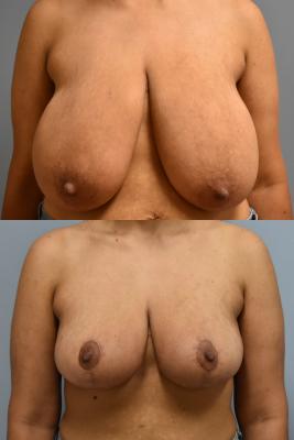 BREAST REDUCTION