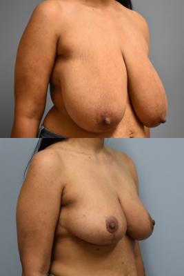 BREAST REDUCTION