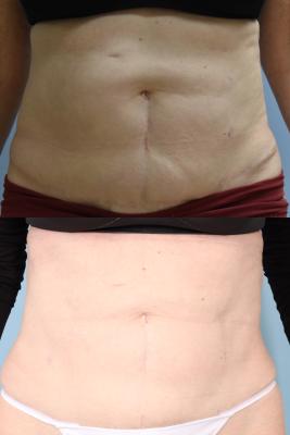 LIPOSUCTION OF ABDOMEN AND POSTRIOR FLANKS