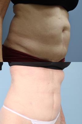 LIPOSUCTION OF ABDOMEN AND POSTRIOR FLANKS