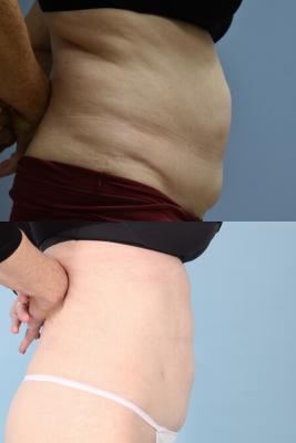 LIPOSUCTION OF ABDOMEN AND POSTRIOR FLANKS