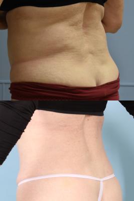 LIPOSUCTION OF ABDOMEN AND POSTRIOR FLANKS