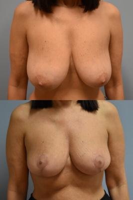ONCOPLASTIC BREAST REDUCTION