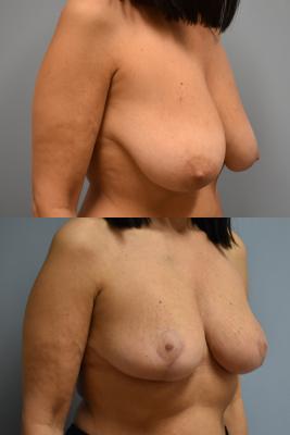 ONCOPLASTIC BREAST REDUCTION