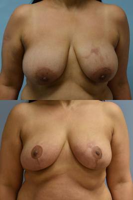 ONCOPLASCTIC BREAST REDUCTION