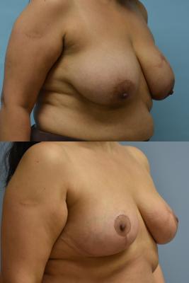 ONCOPLASCTIC BREAST REDUCTION