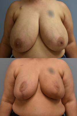 ONCOPLASTIC BREAST REDUCTION