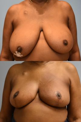 ONCOPLASTIC BREAST REDUCTION