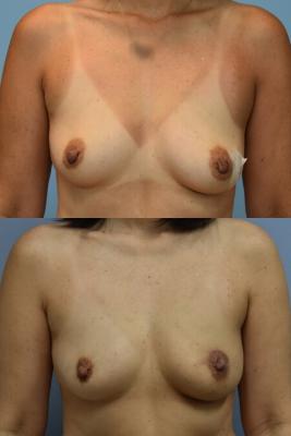 ONCOPLASTIC REDUCTION