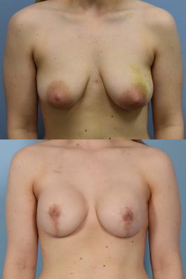 BREAST RECONSTRUCTION WITH TISSUE EXPANDER