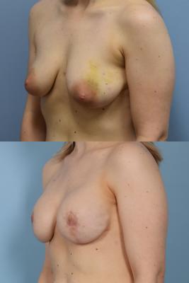 BREAST RECONSTRUCTION WITH TISSUE EXPANDER