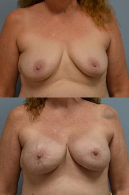 BREAST RECONSTRUCTION WITH TISSUE EXPANDER