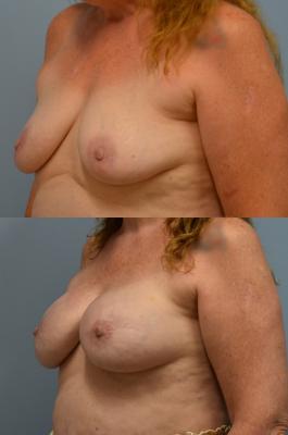 BREAST RECONSTRUCTION WITH TISSUE EXPANDER
