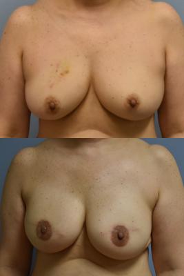 BREAST RECONSTRUCTION WITH TISSUE EXPANDER