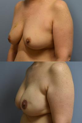 BREAST RECONSTRUCTION WITH TISSUE EXPANDER