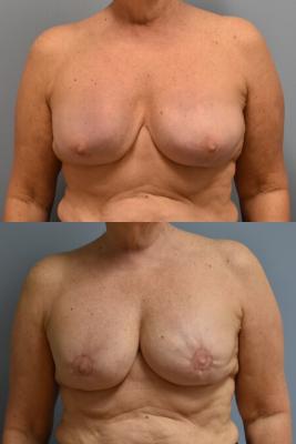 EXPANDER BREAST RECONSTRUCTION