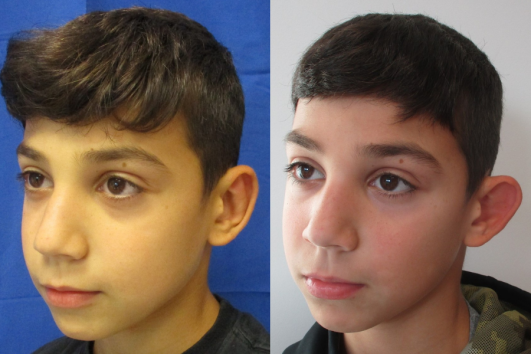 otoplasty of left ear