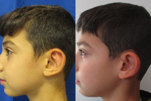 otoplasty of left ear
