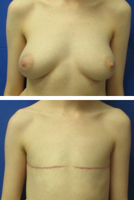 Gender affirming top surgery before & after