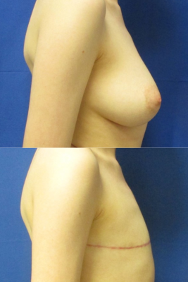 Gender affirming top surgery before & after