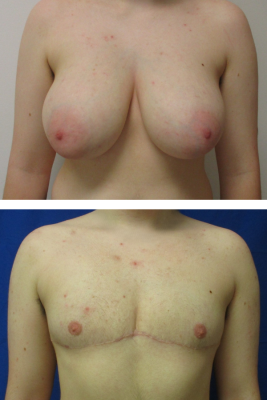 Gender affirming top surgery before & after