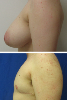 Gender affirming top surgery before & after