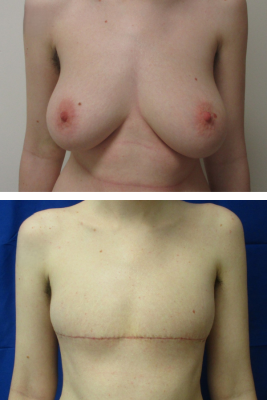 Gender affirming top surgery before & after