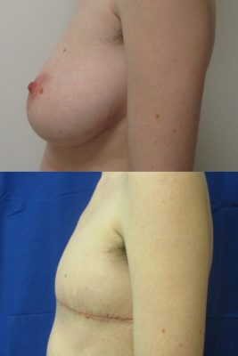 Gender affirming top surgery before & after