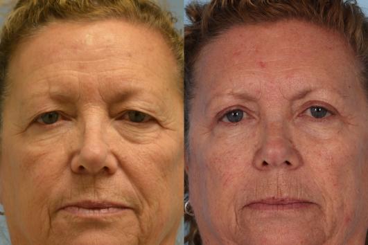 Upper Blepharoplasty before & after