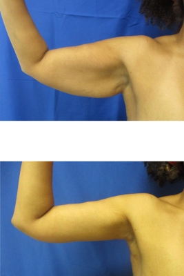 arm lift before & after