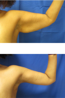 arm lift before & after