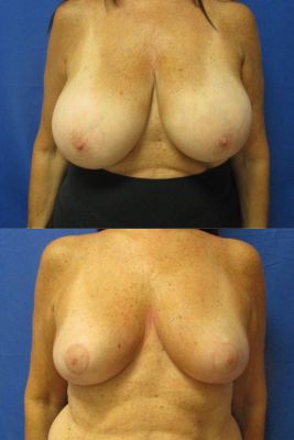 breast reduction before & after