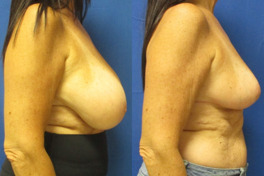 breast reduction before & after