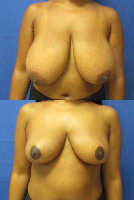 breast reduction before & after