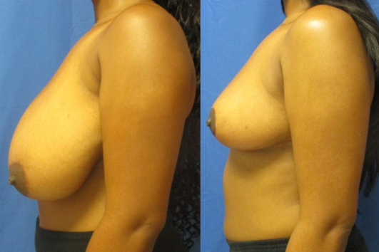 breast reduction before & after