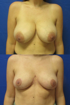 breast reduction before & after