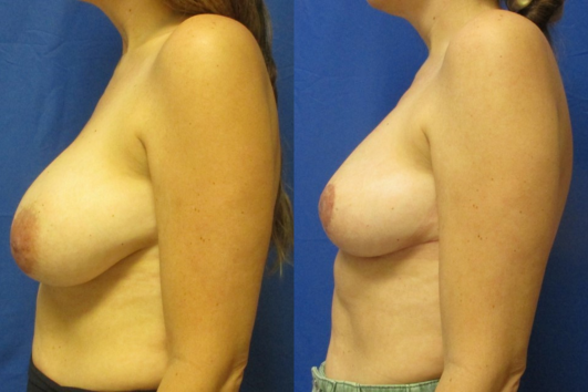 breast reduction before & after