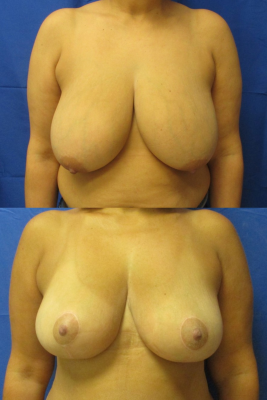 breast reduction before & after