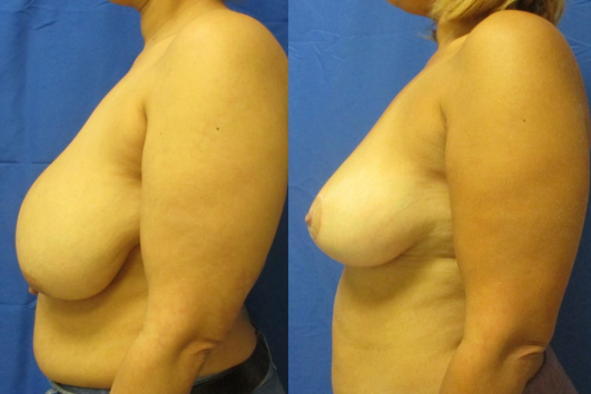 breast reduction before & after