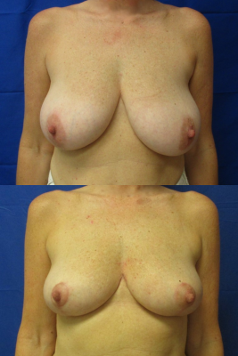 breast reduction before & after