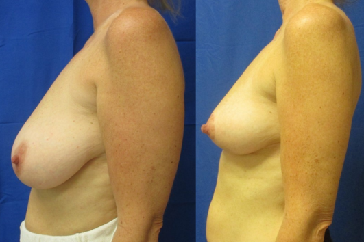 breast reduction before & after