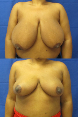 breast reduction before & after