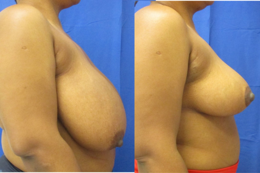 breast reduction before & after