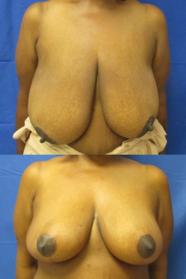 breast reduction before & after