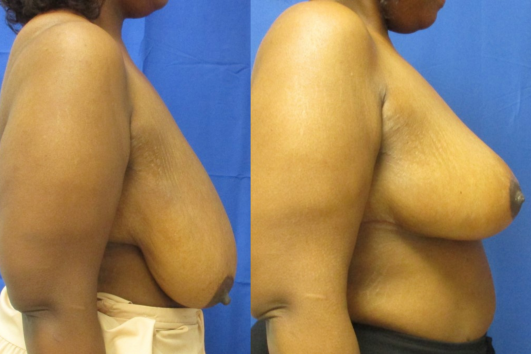 breast reduction before & after